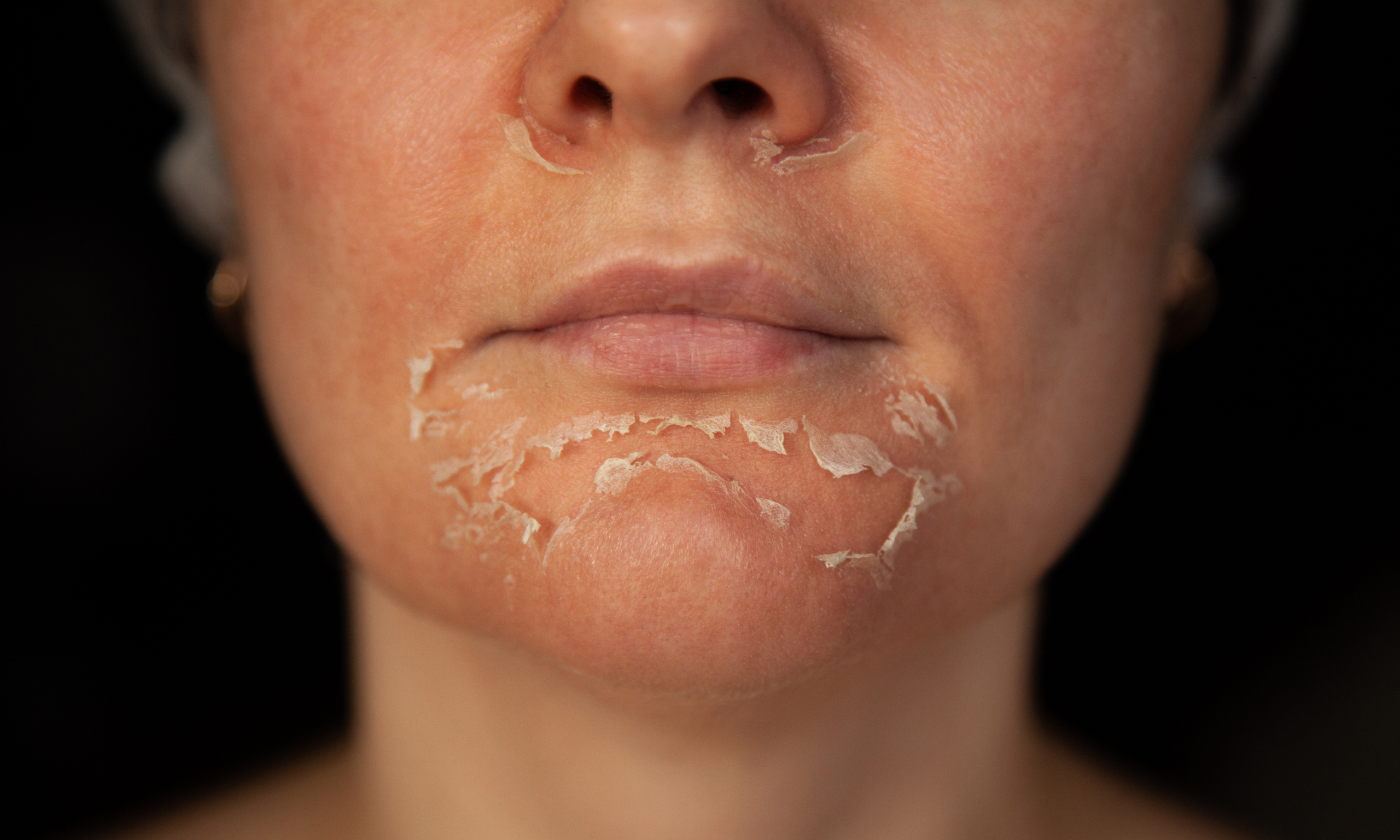 Chemical Peel treatment at Mellovea Medical
